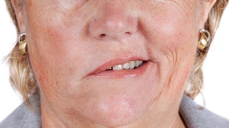 Méo miệng là hệ quả thường gặp khi dây thần kinh số 7 ngoại biên bị tổn thương