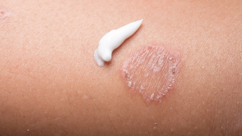 Mẹo chữa hắc lào dân gian hiệu quả và dễ áp dụng tại nhà