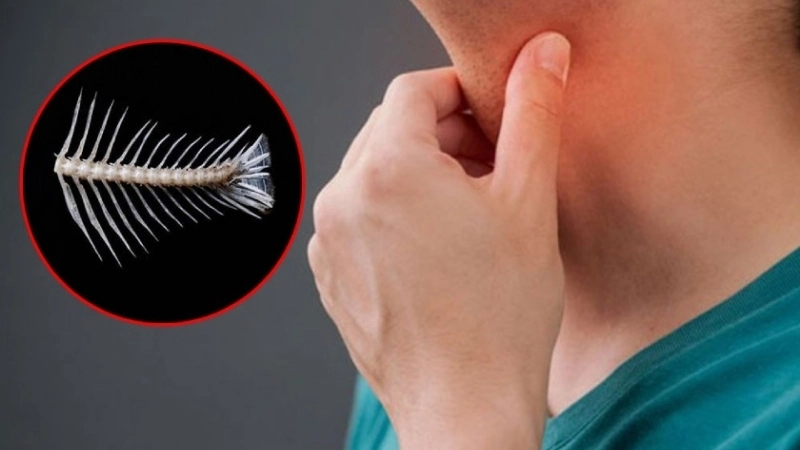 Những mẹo chữa hóc xương cá nhanh nhất