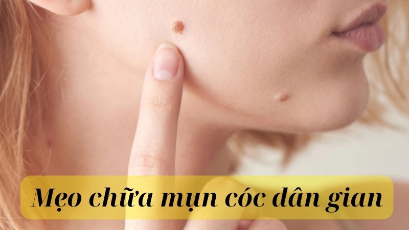 Những mẹo chữa mụn cóc tại nhà từ nguyên liệu tự nhiên