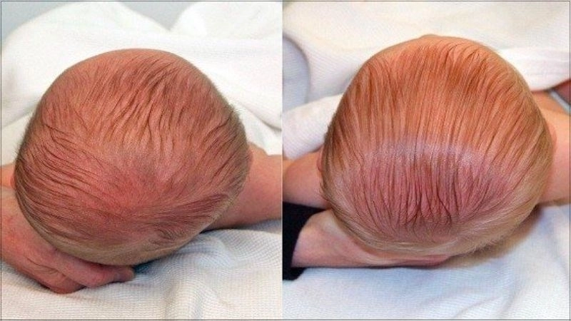 Nhận biết méo đầu ở trẻ sơ sinh qua dấu hiệu thường gặp