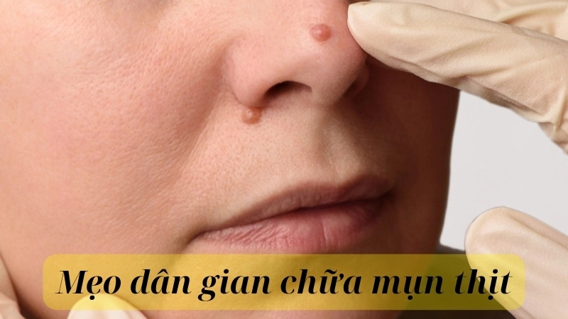 Một số mẹo dân gian chữa mụn thịt hiệu quả tại nhà