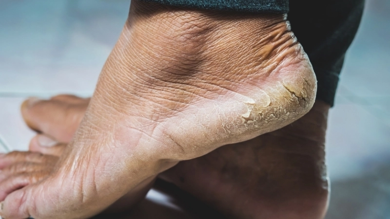 Tình trạng nứt gót chân không chỉ gây mất thẩm mỹ mà còn mang lại cảm giác đau rát