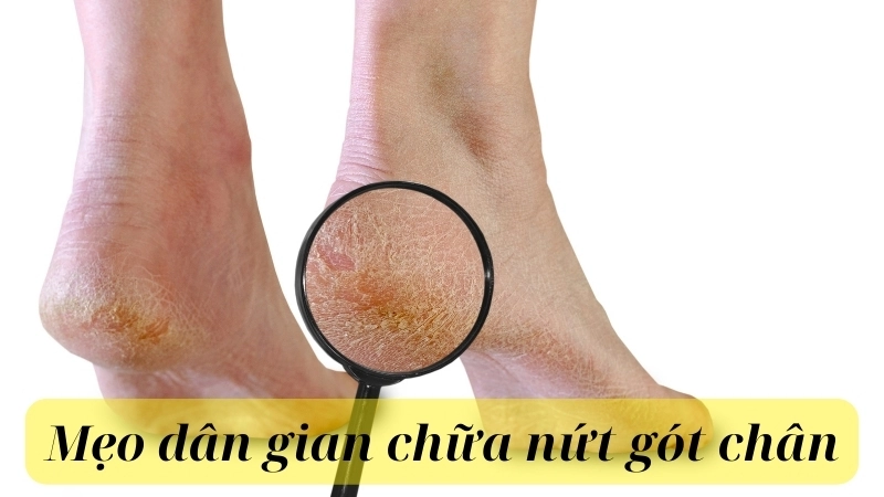 Các bài thuốc dân gian trị nứt gót chân đơn giản tại nhà