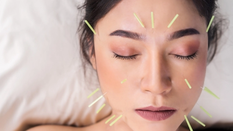 Cách trị rối loạn tiền đình dân gian bằng châm cứu, bấm huyệt