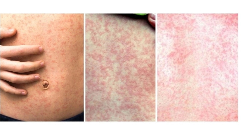 Những lưu ý quan trọng khi sử dụng mẹo dân gian chữa sởi