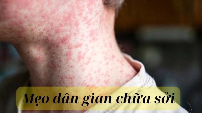 Các mẹo dân gian chữa sởi an toàn, hiệu quả