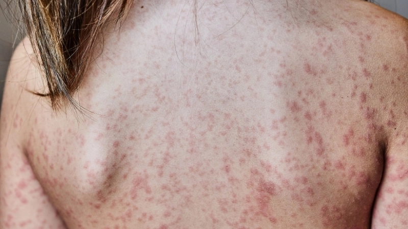 Các mẹo dân gian chữa phát ban thường giúp cơ thể dễ chịu hơn