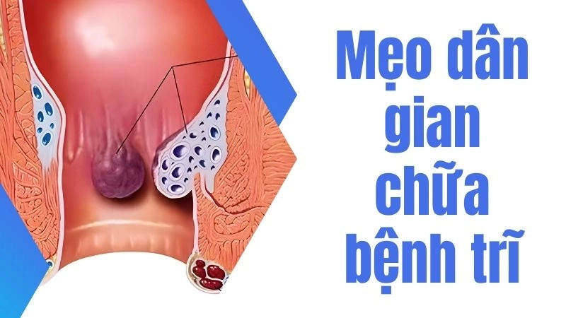 Dùng rau diếp cá làm mát và co búi trĩ nhanh