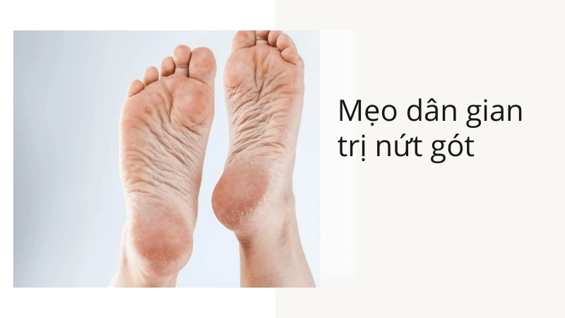 Những mẹo dân gian trị nứt nẻ gót chân cực hay