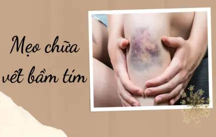Mẹo chữa vết bầm tím giúp da phục hồi cực nhanh tại nhà