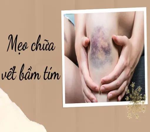 Mẹo chữa vết bầm tím giúp da phục hồi cực nhanh tại nhà