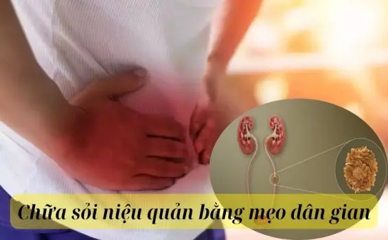 Cách chữa sỏi niệu quản bằng mẹo dân gian không cần thuốc
