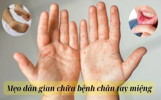 Chia sẻ mẹo dân gian chữa bệnh chân tay miệng từ dân gian xưa