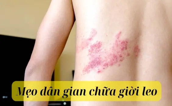 Mẹo dân gian chữa giời leo nhanh khỏi không để lại sẹo