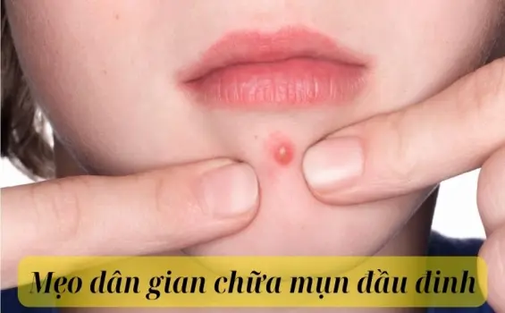 Gợi ý mẹo dân gian chữa mụn đầu đinh nhanh và tiết kiệm