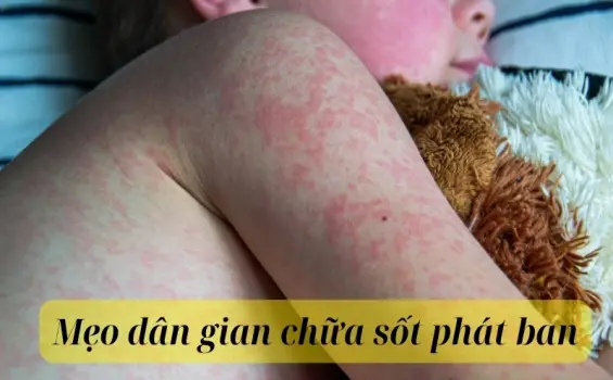 Những mẹo dân gian chữa sốt phát ban nhanh chóng tại nhà