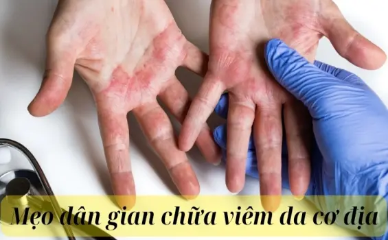 Các mẹo dân gian chữa viêm da cơ địa phổ biến nhất