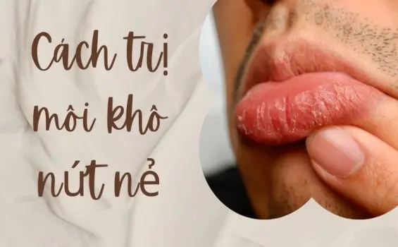 Cách trị môi khô nứt nẻ dứt điểm không cần son dưỡng