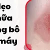 Mẹo chữa bỏng bô xe máy theo kinh nghiệm từ dân gian
