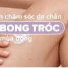 12 Mẹo Chữa Bong Da Chân Tại Nhà Đơn Giản, Hiệu Quả