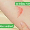 Bị bỏng bôi gì nhanh khỏi và an toàn?