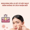 Bí quyết trị mụn đinh râu hiệu quả tại nhà và cách phòng tránh