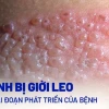 Giời Leo là Bệnh gì? Nguyên nhân, Dấu hiệu và Cách điều trị hiệu quả