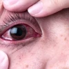 Mách bạn mẹo chữa đau mắt đỏ nhanh nhất và hiệu quả tại nhà
