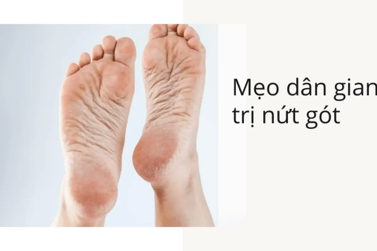 Cách trị nứt nẻ gót chân tại nhà: Mẹo dân gian giúp gót hồng