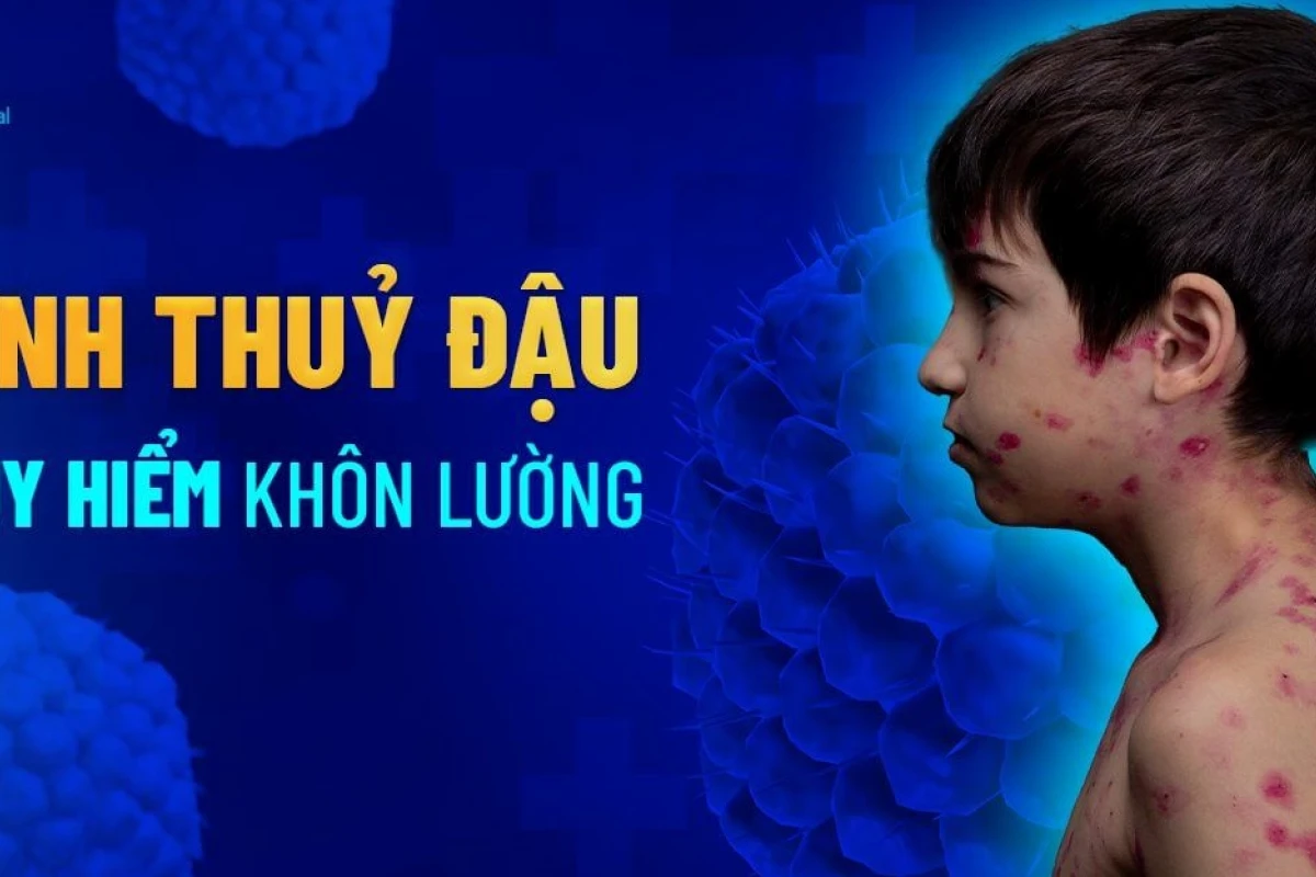 Bệnh thủy đậu là gì? Nguyên nhân, triệu chứng và cách phòng ngừa