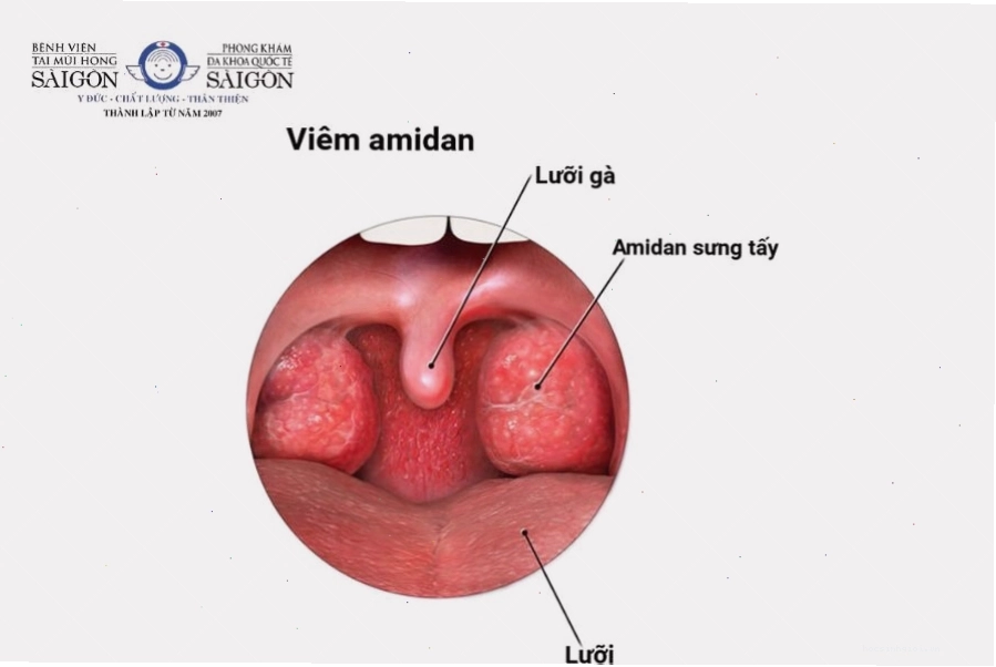 Amidan sưng to là một nguyên nhân phổ biến gây cảm giác vướng cổ họng