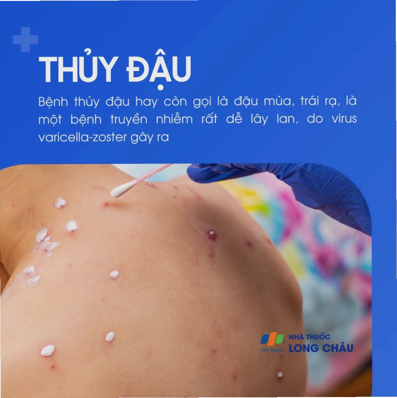 Bệnh thủy đậu là bệnh truyền nhiễm do virus Varicella zoster gây ra, rất dễ lây