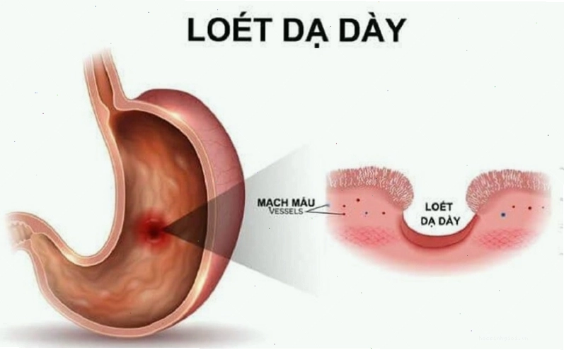 Bệnh viêm loét dạ dày có thể gây nên triệu chứng xót ruột