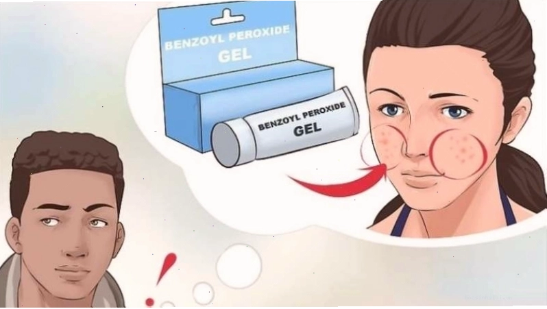 Benzoyl peroxide giúp kiểm soát dầu thừa, làm khô bã nhờn
