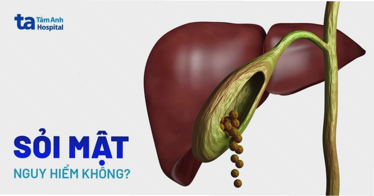 Biến chứng nguy hiểm của sỏi mật
