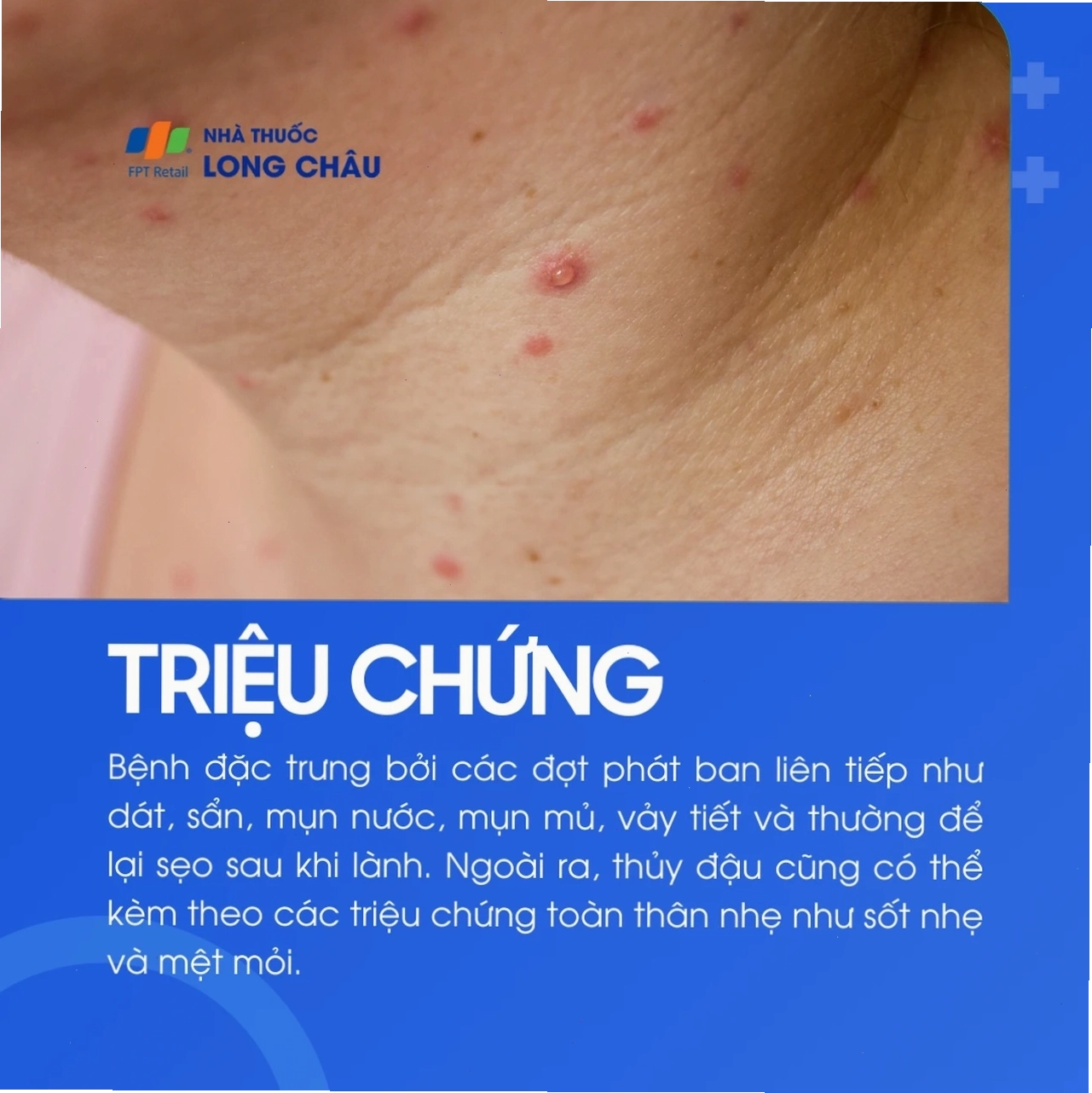 Các nốt phát ban và mụn nước điển hình của bệnh thủy đậu trên da bệnh nhân