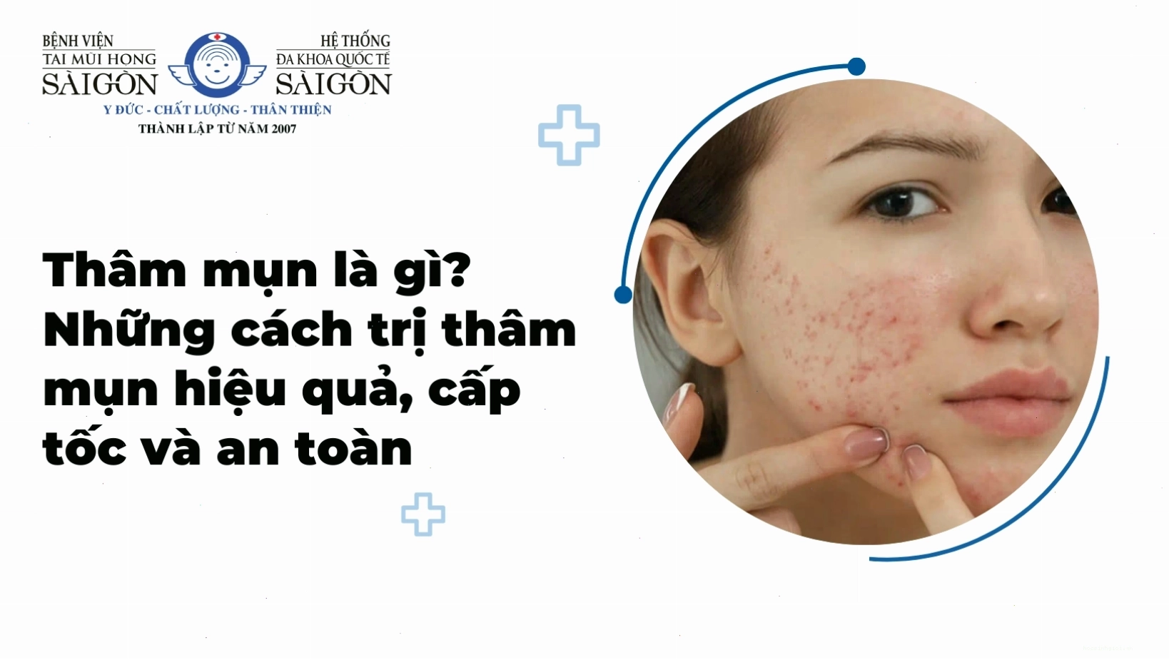 Các phương pháp trị thâm mụn hiệu quả và an toàn