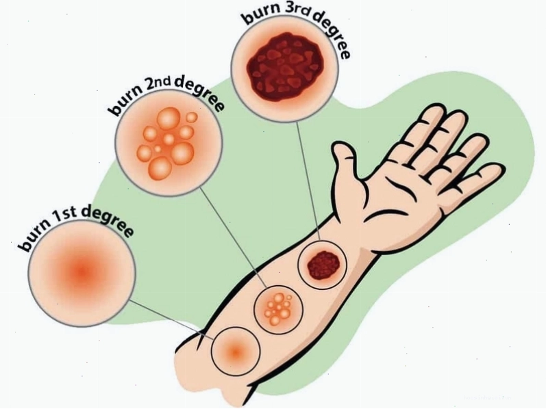 Chế độ dinh dưỡng và chăm sóc da non sau bỏng