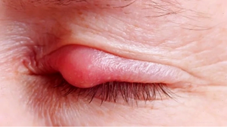 Cột chỉ là mẹo dân gian để chữa lẹo mắt