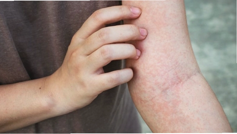 Dầu dừa làm dịu cảm giác ngứa da