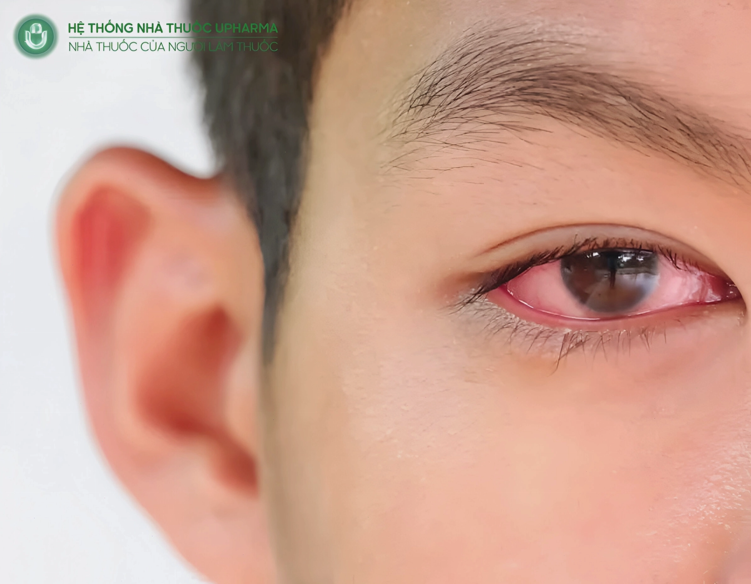 Đau mắt đỏ là gì và các triệu chứng nhận biết