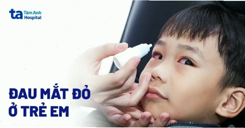 Đau mắt đỏ ở trẻ em cần được cha mẹ quan tâm và xử lý đúng cách