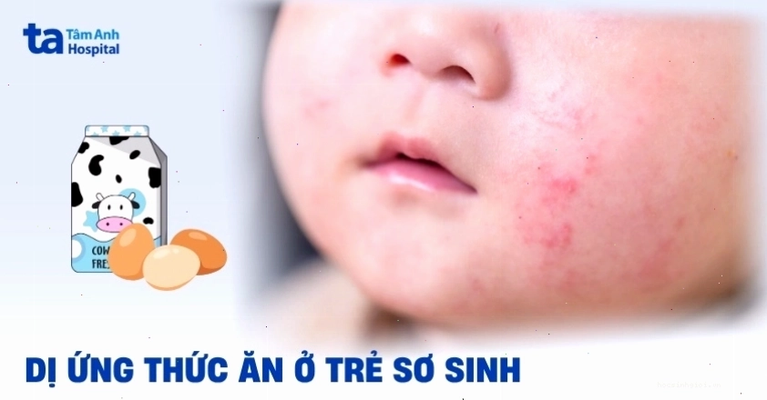 Dị ứng thức ăn ở trẻ sơ sinh cần được theo dõi sát sao