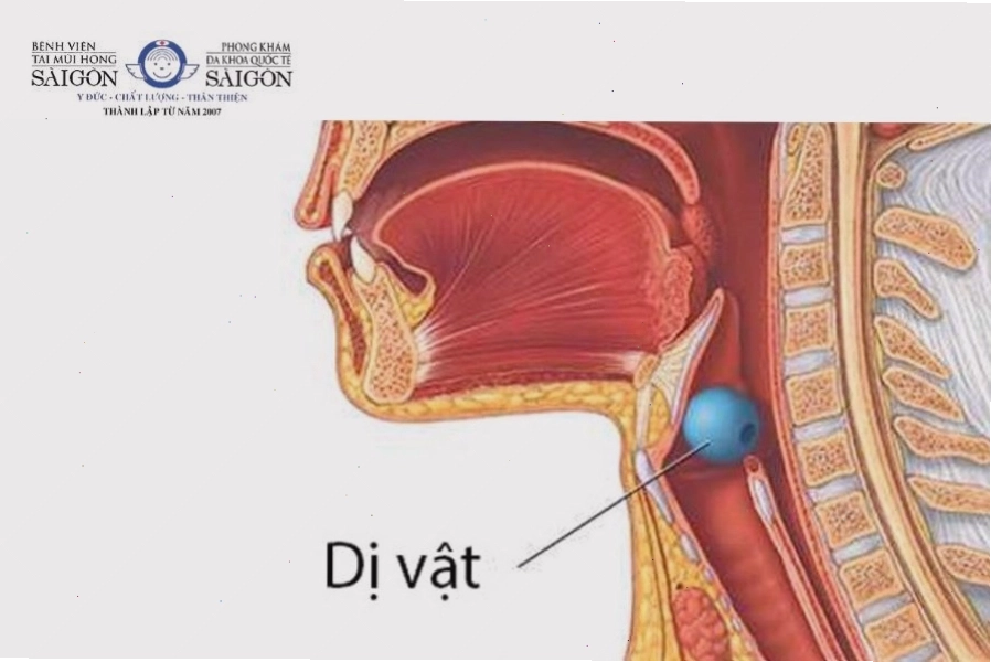 Dị vật mắc kẹt trong cổ họng gây cảm giác vướng víu