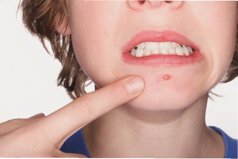 Giữ vệ sinh da mặt sạch sẽ là biện pháp quan trọng khi bị mụn trứng cá hoặc mụn đinh râu