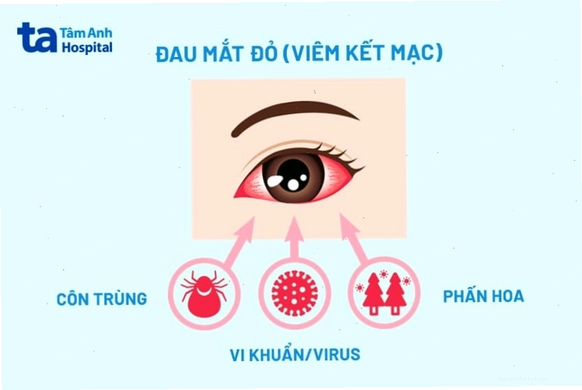 Hình ảnh minh họa đôi mắt bị đỏ và sưng do viêm kết mạc