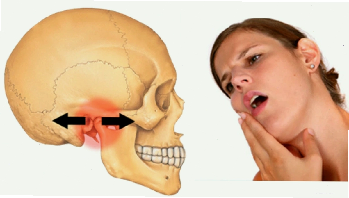 Hình ảnh minh họa khớp thái dương hàm bị viêm gây đau quai hàm