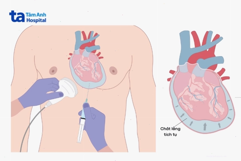 Hình ảnh minh họa kỹ thuật chọc hút dịch màng ngoài tim