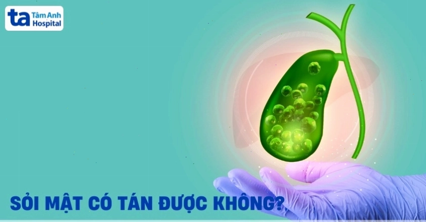 Hình ảnh minh họa quy trình tán sỏi mật